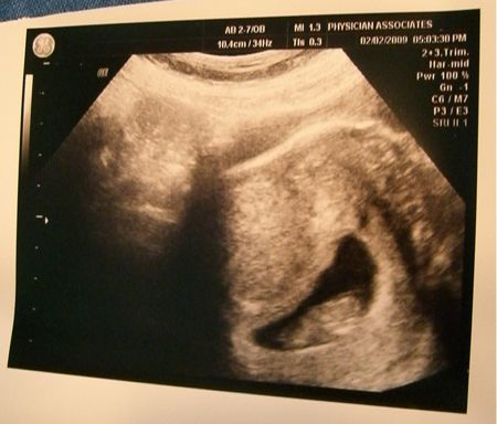 #3 at 9.5 weeks