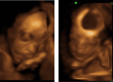 James at 27 wks.